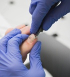 צלקת - תמונת המחשה