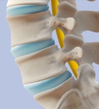 נוירופיברומטוזיס - תמונת המחשה