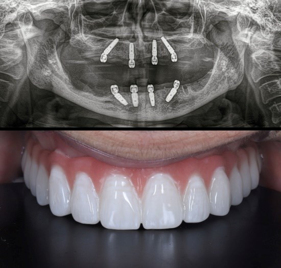 אחוזי הצלחה גבוהים לשתלי שיניים
