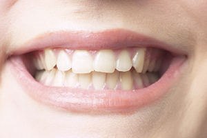 כוויה בפה - תמונת אווירה