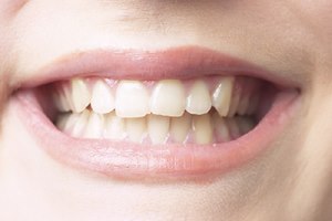 יישור שיניים: עוזרים לגנטיקה-תמונה