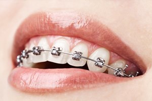 ליקויי סגר: שיניים ישרות, חיוך גדול-תמונה