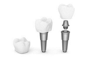 טשטוש ורידי - תמונת המחשה