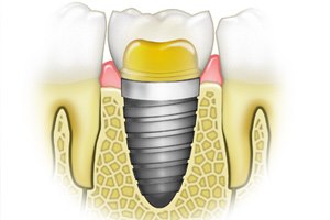 שתלים ודלקות חניכיים: מפגש כואב-תמונה