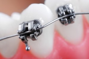 כל הדרכים ליישור שיניים-תמונה