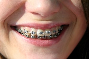 קיבועים - תמונת המחשה