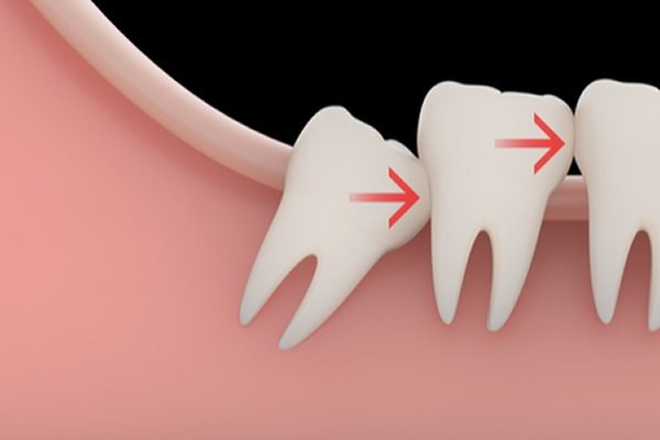 שיוף שיניים - תמונת אווירה