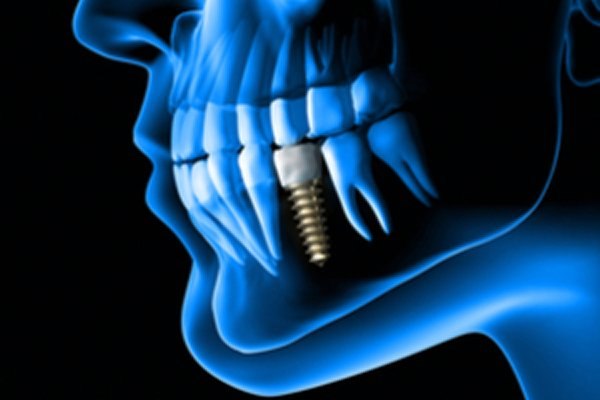 השתלת שיניים: כל מה שחשוב לדעת-תמונה