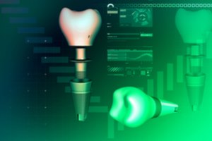 השתלות שיניים מונחות מחשב-תמונה