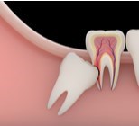 המדריך השלם לפגיעה עצבית בניתוחים לעקירת שיני בינה-תמונה