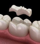 השן נשברה? יש אלטרנטיבה לטיפול שורש ועקירה-תמונה