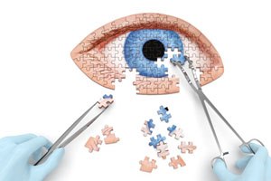 קטרקט (אילוסרציה צילום shutterstock(