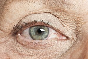 ניוון רשתית - תמונת אווירה