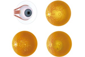 זריקות לוסנטיס - תמונת המחשה