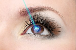 הסרת משקפיים בלייזר - תמונת המחשה