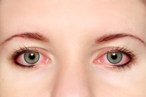 דלקת ענביה בעין: זהירות מסיבוכים קשים-תמונה