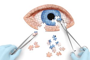 גלאוקומה וקטרקט: קשר גומלין-תמונה