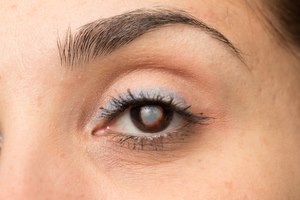 ניתוח קטרקט: לכל שאלה - תשובה-תמונה