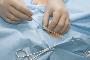 ניתוחי בטן חוזרים