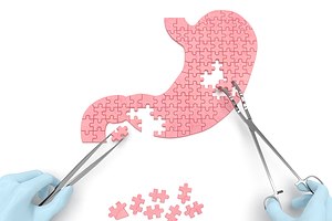 חדש: ניתוח מיני מעקף קיבה-תמונה