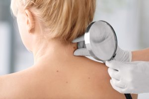 גידולי עור באזור הראש והצוואר-תמונה