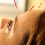 סוף לכאב: טיפול ברפואה סינית-תמונה