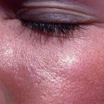 כשהעור מתעטש-תמונה