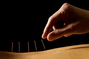 דיקור סיני לילדים ותינוקות-תמונה