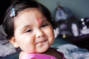 המנגיומה מולדת - תמונת המחשה