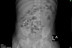  צילום הרנטגן של הפעוטה, וסיכת הביטחון לאחר הוצאתה. צילום: דוברות רמב'ם