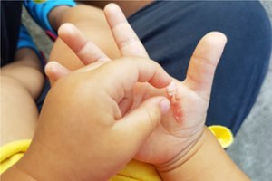 2,400 ילדים נכוו מנוזלים חמים-תמונה