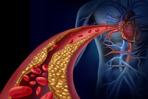 כולסטרול גבוה: התרופות החדשות-תמונה