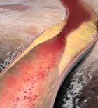 סתימת עורקים - תמונת המחשה