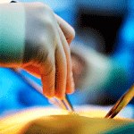 סרטן המעי הגס: הפתרונות הכירורגיים-תמונה