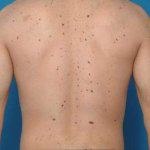 מלנומה: גילוי מוקדם מציל חיים-תמונה