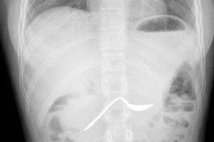 COPD: לדעת יותר על המחלה-תמונה