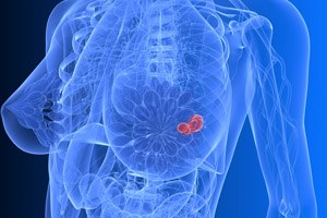 סרטן - מהשד לריאה-תמונה