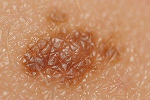 זהירות, הקשר בין ויאגרה לסרטן-תמונה