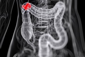 בדיקת קולונוסקופיה (אילוסטרציה)