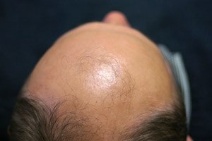 האם קרחת מנבאת סרטן?-תמונה