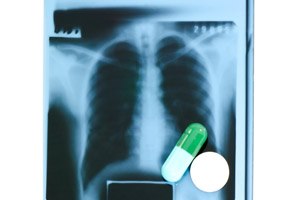 TAGRISSO: בשורה לחולי סרטן הריאה-תמונה