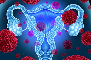 סרטן השחלה: חשוב להגביר מודעות-תמונה