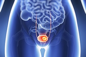 סרטן שלפוחית השתן: לגלות בזמן-תמונה