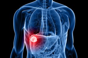 גידול בכבד - תמונת אווירה