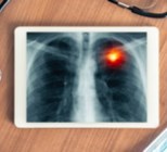 אסבסטוזיס - תמונת אווירה