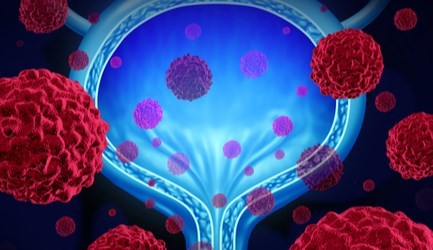 סרטן בשלפוחית השתן - תמונת המחשה