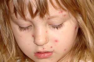 האם מגבונים גורמים לפריחה?-תמונה