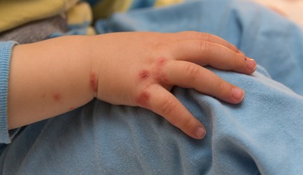 מחלת הפה והגפיים - תמונת המחשה