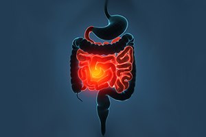 קרוהן וקוליטיס: על תזונה כירורגית שמעתם?-תמונה