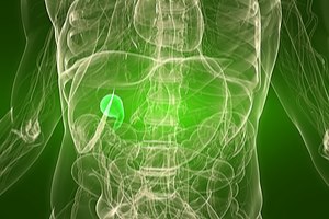 אבנים בכיס המרה: ניתוח לפרוסקופי-תמונה